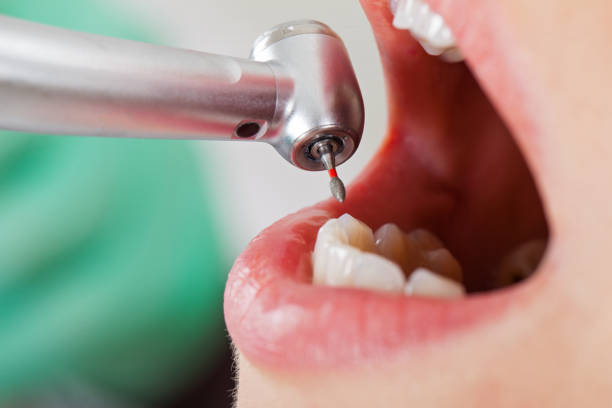 Best Emergency Root Canal Treatment in Okolona, MS